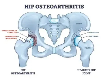 Hip Pain Relief Cedar Park, TX | Bell District Spine and Rehab