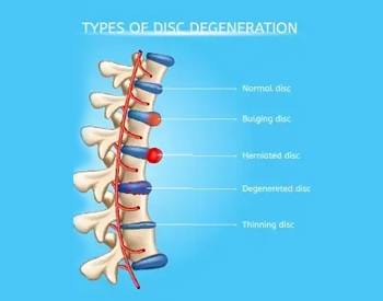 Disc Injury Pain Relief Cedar Park, TX | Bell District Spine and Rehab