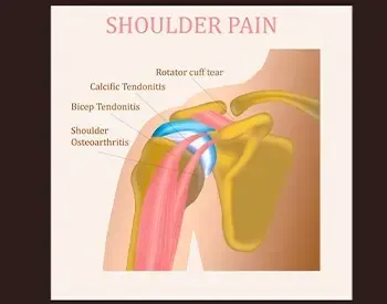 Shoulder Pain Relief Cedar Park, TX | Bell District Spine and Rehab